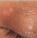 D.A.S. Medical - Xanthelasma - Turkeyana Clinic