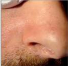 D.A.S. Medical - Fibroma - Turkeyana Clinic