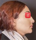 Rhinoplasty - Turkeyana Clinic