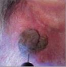 D.A.S. Medical - Keratosis - Turkeyana Clinic