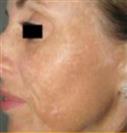 Q Switch Laser Application - Turkeyana Clinic