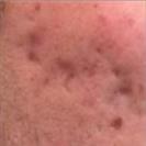 D.A.S. Medical - Acne Scars - Turkeyana Clinic