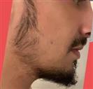 Beard Transplantation - Turkeyana Clinic