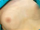 Breast Augmentation - Turkeyana Clinic