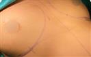 Breast Augmentation - Turkeyana Clinic