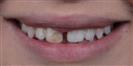 Dental Crown - Turkeyana Clinic