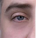 Lower Eyelid Surgery (Blepharoplasty) - Turkeyana Clinic