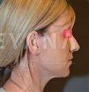 Facelift - Turkeyana Clinic