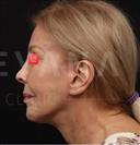 Facelift - Turkeyana Clinic