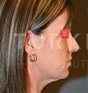 Facelift - Turkeyana Clinic