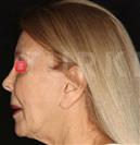 Facelift - Turkeyana Clinic