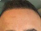 Hair Transplant - Turkeyana Clinic