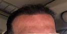 Hair Transplant - Turkeyana Clinic