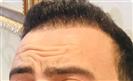 Hair Transplant - Turkeyana Clinic