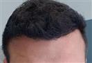 Hair Transplant - Turkeyana Clinic