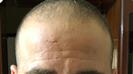 Hair Transplant - Turkeyana Clinic