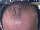 Hair Transplant - Turkeyana Clinic