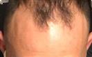 Hair Transplant - Turkeyana Clinic