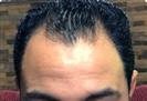 Hair Transplant - Turkeyana Clinic