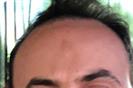 Hair Transplant - Turkeyana Clinic