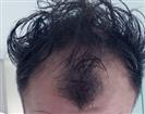 Hair Transplant - Turkeyana Clinic