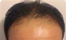 Hair Transplant - Turkeyana Clinic