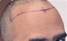 Hair Transplant - Turkeyana Clinic