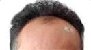 Hair Transplant - Turkeyana Clinic