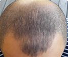 Hair Transplant - Turkeyana Clinic