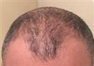 Hair Transplant - Turkeyana Clinic