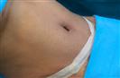 Abdominal Liposuction - Turkeyana Clinic