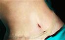 Abdominal Liposuction - Turkeyana Clinic