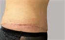 Abdominal Liposuction - Turkeyana Clinic