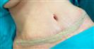 Abdominal Liposuction - Turkeyana Clinic