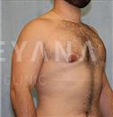 Gynecomastia Surgery - Turkeyana Clinic