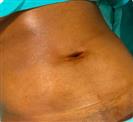 Abdominal Liposuction - Turkeyana Clinic