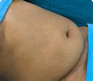 Abdominal Liposuction - Turkeyana Clinic