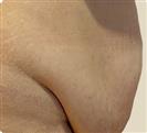 Abdominal Liposuction - Turkeyana Clinic