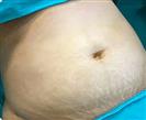 Abdominal Liposuction - Turkeyana Clinic