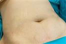 Abdominal Liposuction - Turkeyana Clinic