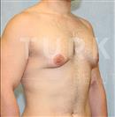 Gynecomastia Surgery - Turkeyana Clinic