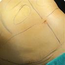 Abdominal Liposuction - Turkeyana Clinic