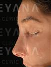 Rhinoplasty - Turkeyana Clinic