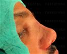 Rhinoplasty - Turkeyana Clinic