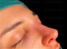 Rhinoplasty - Turkeyana Clinic