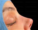 Rhinoplasty - Turkeyana Clinic