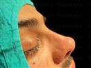 Rhinoplasty - Turkeyana Clinic