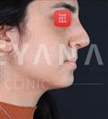 Rhinoplasty - Turkeyana Clinic