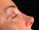 Rhinoplasty - Turkeyana Clinic