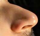 Rhinoplasty - Turkeyana Clinic